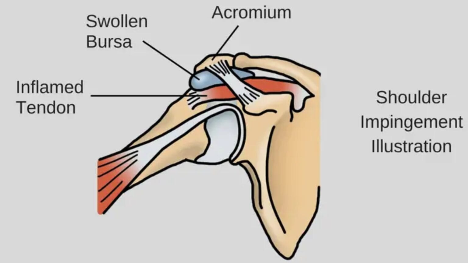 What are the Main Causes of Shoulder Impingement?